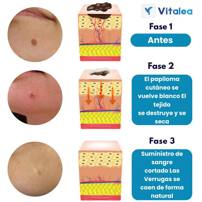 VerruClean®️ Tratamiento profesional Completo para Verrugas