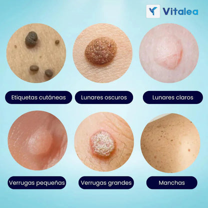 VerruClean®️ Tratamiento profesional Completo para Verrugas