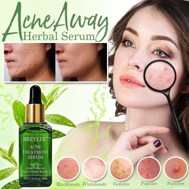 Mascarilla Esmalte facial Breylee ®️ Único en el mercado, elimina machas, acné, espinillas, puntos negros y cierra poros