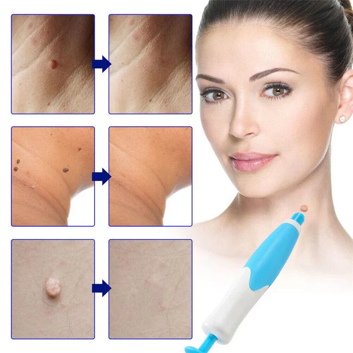 VerruClean®️ Tratamiento profesional Completo para Verrugas