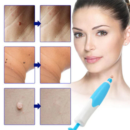 VerruClean®️ Tratamiento profesional Completo para Verrugas