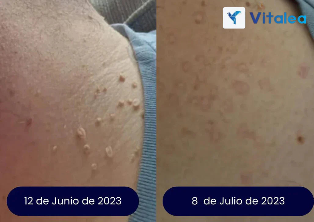 VerruClean®️ Tratamiento profesional Completo para Verrugas