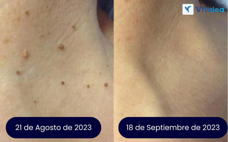 VerruClean®️ Tratamiento profesional Completo para Verrugas