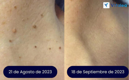 VerruClean®️ Tratamiento profesional Completo para Verrugas